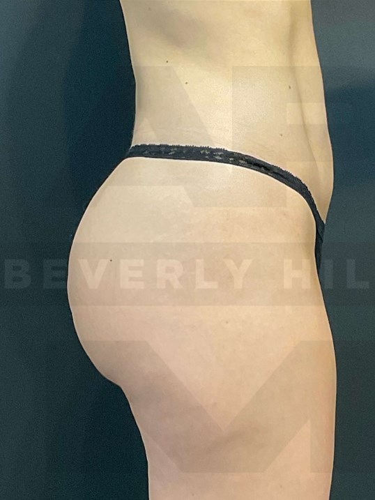 Petite BBL (BMI 22)Brazilian Butt Lift with Lipo360 in Beverly